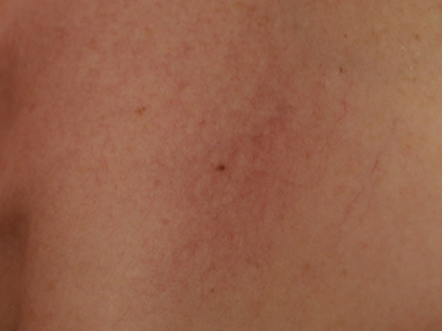 Varicosit&eacute; apr&egrave;s laser