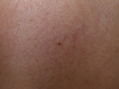 Varicosit&eacute; avant laser